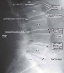 Degenerative Disc Disease