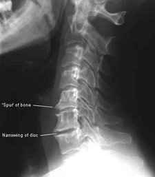  Degenerative Disc Disease